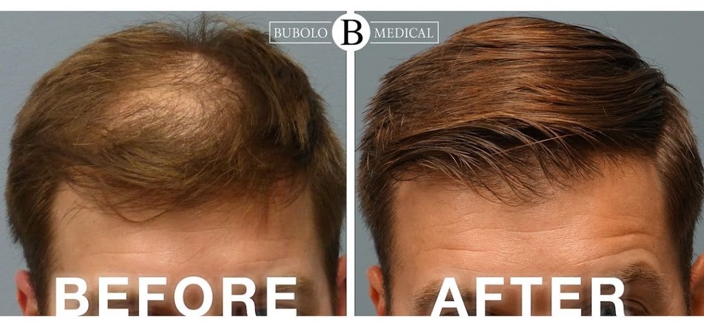 Bubolo Hair Restoration | 3889 Cobb Pkwy NW, Acworth, GA 30101, USA | Phone: (770) 766-8374