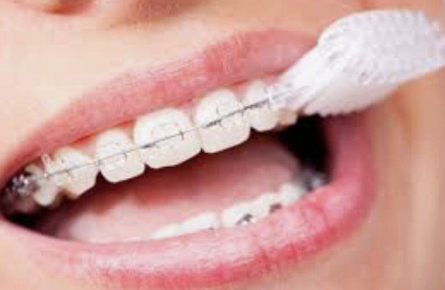 Unlimited Smiles Orthodontics | 7000 Bay Pkwy, Brooklyn, NY 11204, USA | Phone: (718) 256-0022