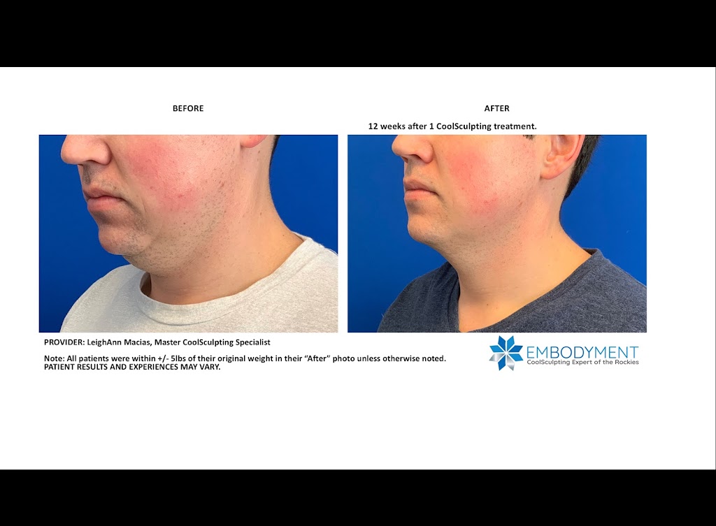 EMBODYMENT - CoolSculpting Expert of The Rockies | 12201 N Pecos St #100, Denver, CO 80234, USA | Phone: (720) 231-7885