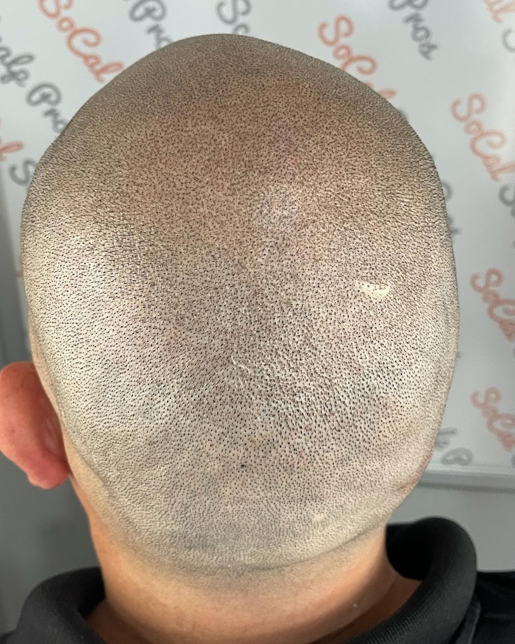 Scalp Mora Pigmentation | 1079 Lua Hala Canyon Rd, Vista, CA 92081, USA | Phone: (760) 583-4853