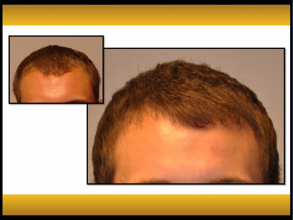 Fallon Hair Restoration | 9735 SW Shady Ln, Tigard, OR 97223, USA | Phone: (503) 941-5029