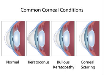 Minnesota Eye Consultants | 7125 Tamarack Rd Suite 100, Woodbury, MN 55125, USA | Phone: (651) 748-4444