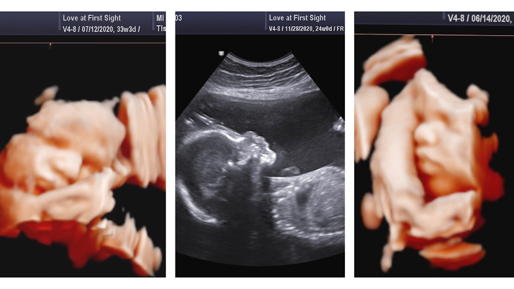 Love At First Sight 3D/4D HD Ultrasound | 3321 Colorado Blvd, Denton, TX 76210, USA | Phone: (940) 727-1272