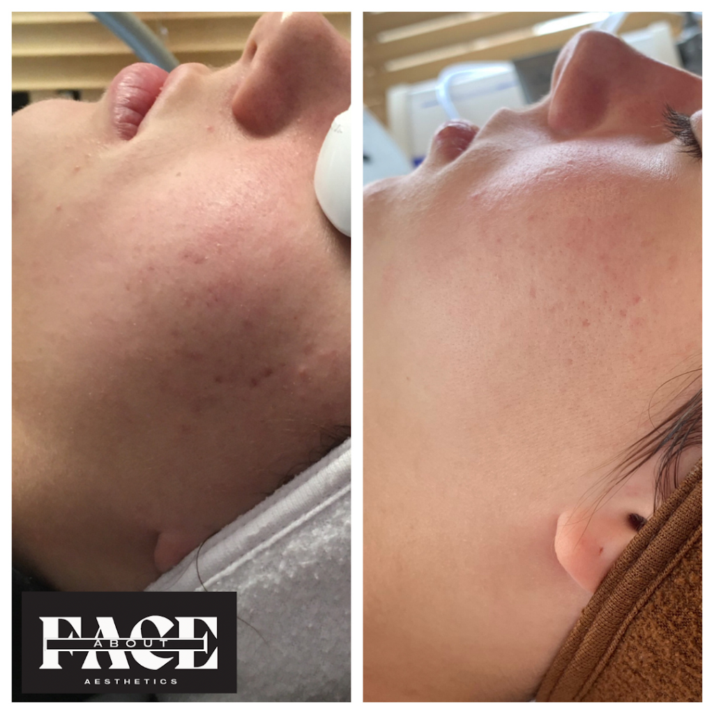 About Face Aesthetics | Studio 12, 588 N Lincoln Ave, Loveland, CO 80537, USA | Phone: (970) 744-3064 About Face Aesthetics | Studio 12, 588 N Lincoln Ave, Loveland, CO 80537, USA | Phone: (970) 744-3064