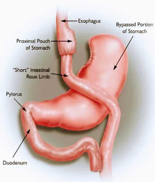 Michigan Bariatric Surgery - Dr. Jason Rizqallah, MD | 28455 Haggerty Rd suite 203, Novi, MI 48377, USA | Phone: (248) 831-0806