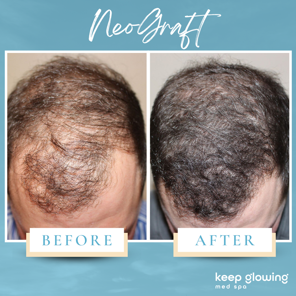 FUE Hair Transplant Solution New Jersey | 4057 Asbury Ave Suite 021, Tinton Falls, NJ 07753, USA | Phone: (848) 420-9970