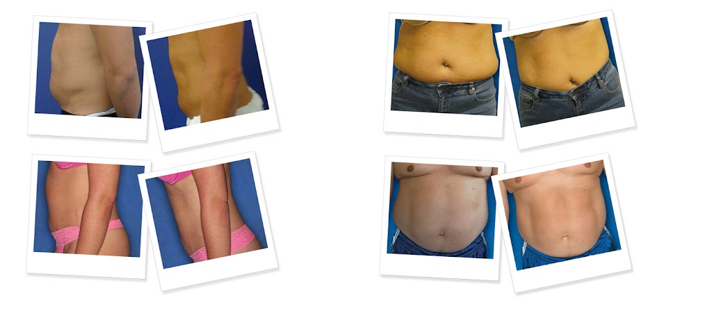 SoCal Body Contouring | 811 W San Marcos Blvd, San Marcos, CA 92078, USA | Phone: (760) 744-8223