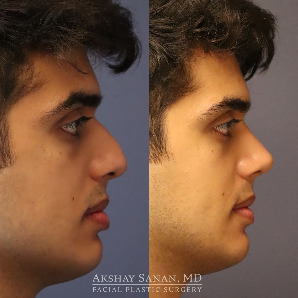 Akshay Sanan MD Facial Plastic Surgery | 69 Newbury St 5th floor, Boston, MA 02116, USA | Phone: (617) 450-0070