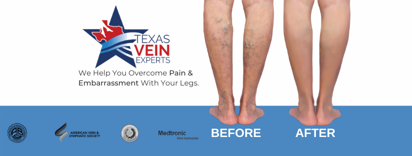 Texas Vein Experts - Little Elm | 1395 E Eldorado Pkwy Suite 300, Little Elm, TX 75068, USA | Phone: (817) 668-1360