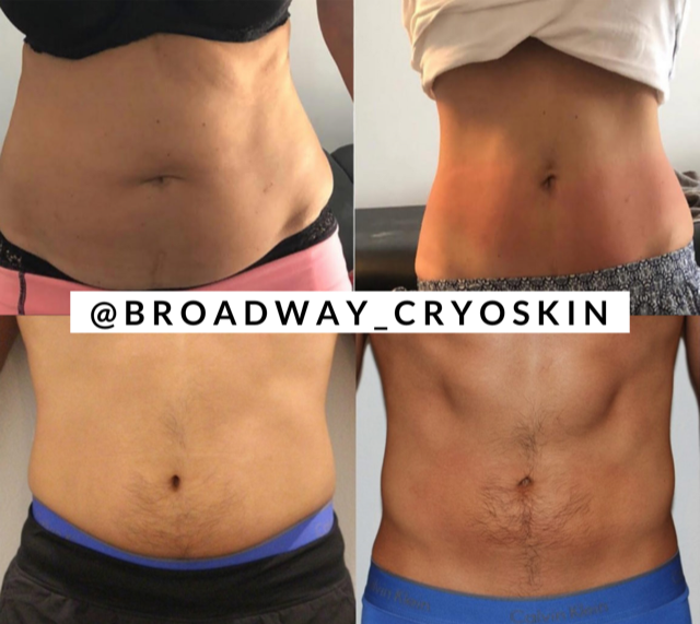 Broadway Cryoskin | 763 S Main St, Orange, CA 92868, USA | Phone: (949) 409-1160