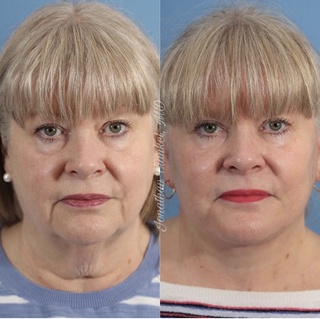 Frankel Facial Plastic Surgery, LLC: Jonathan Frankel, MD | 5885 Landerbrook Dr Suite 150, Mayfield Heights, OH 44124, USA | Phone: (216) 399-9550