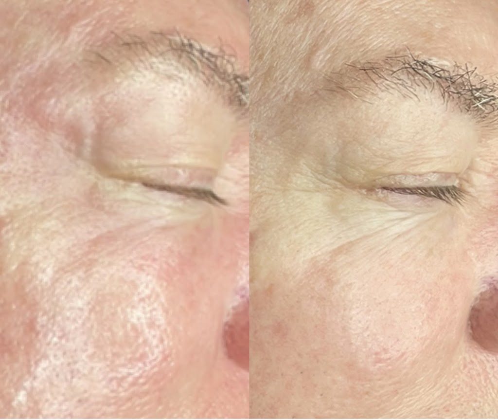 Hydrafacial and Chemical Peels by Kapri Skin | 7077 E Bell Rd Suite 200-102, Scottsdale, AZ 85254, USA | Phone: (480) 229-2324