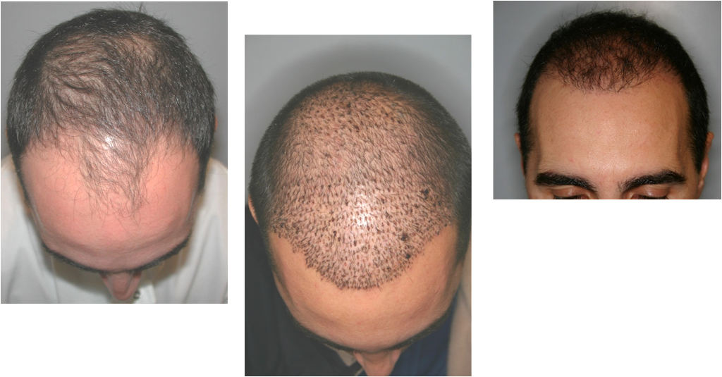 Buffalo Hair Transplant Center | 5007 Transit Rd Suite #2, Depew, NY 14043, USA | Phone: (716) 428-3998