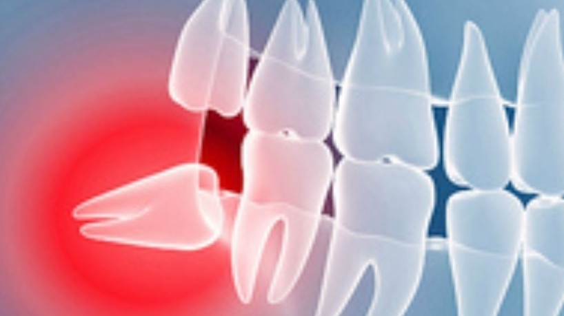 Silicon Valley Wisdom Teeth | 5710 Cahalan Ave Building 8K, San Jose, CA 95123, USA | Phone: (408) 578-5911