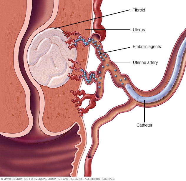 The Zenith Fibroid Center | 5740 Getwell Rd Building 3 Unit B, Southaven, MS 38672, USA | Phone: (662) 655-1090