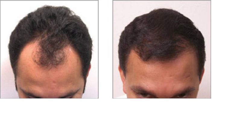 Buffalo Hair Transplant Center | 5007 Transit Rd Suite #2, Depew, NY 14043, USA | Phone: (716) 428-3998