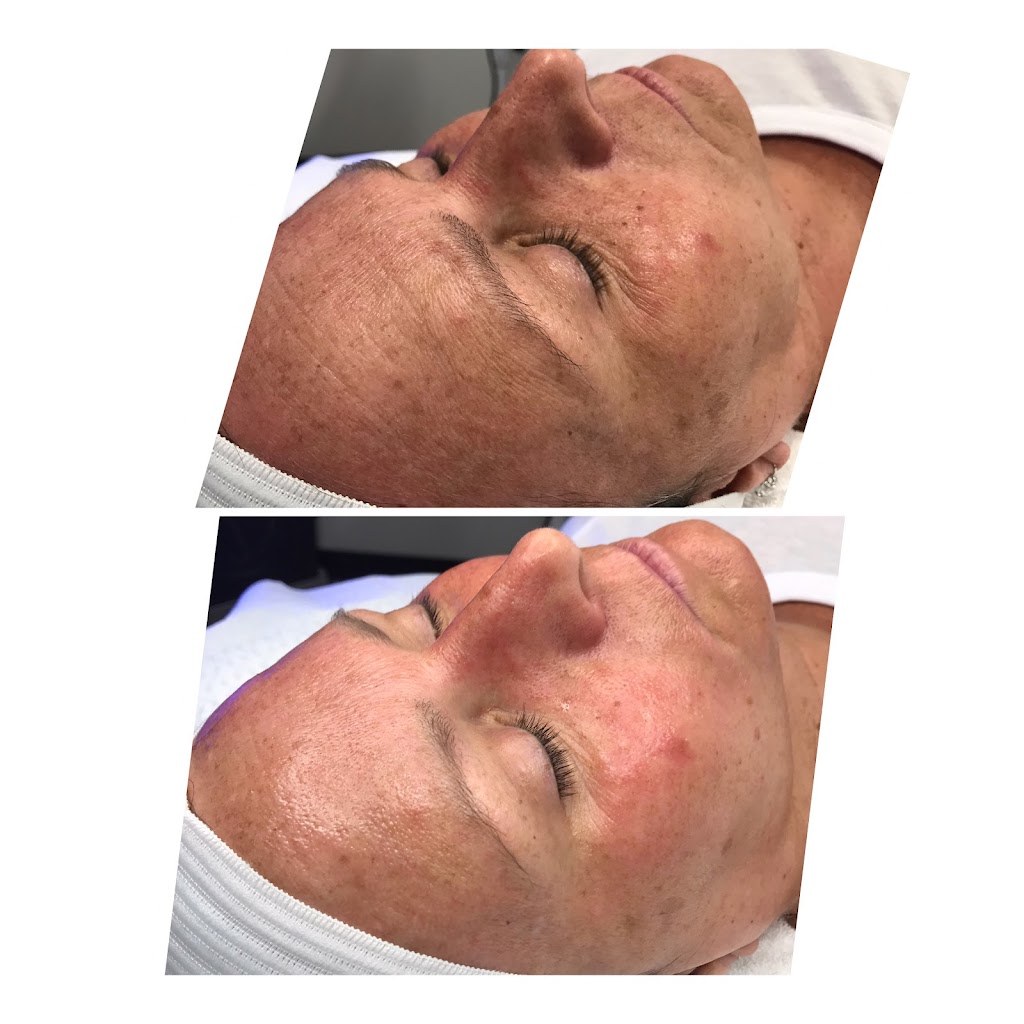 Hydrafacial and Chemical Peels by Kapri Skin | 7077 E Bell Rd Suite 200-102, Scottsdale, AZ 85254, USA | Phone: (480) 229-2324