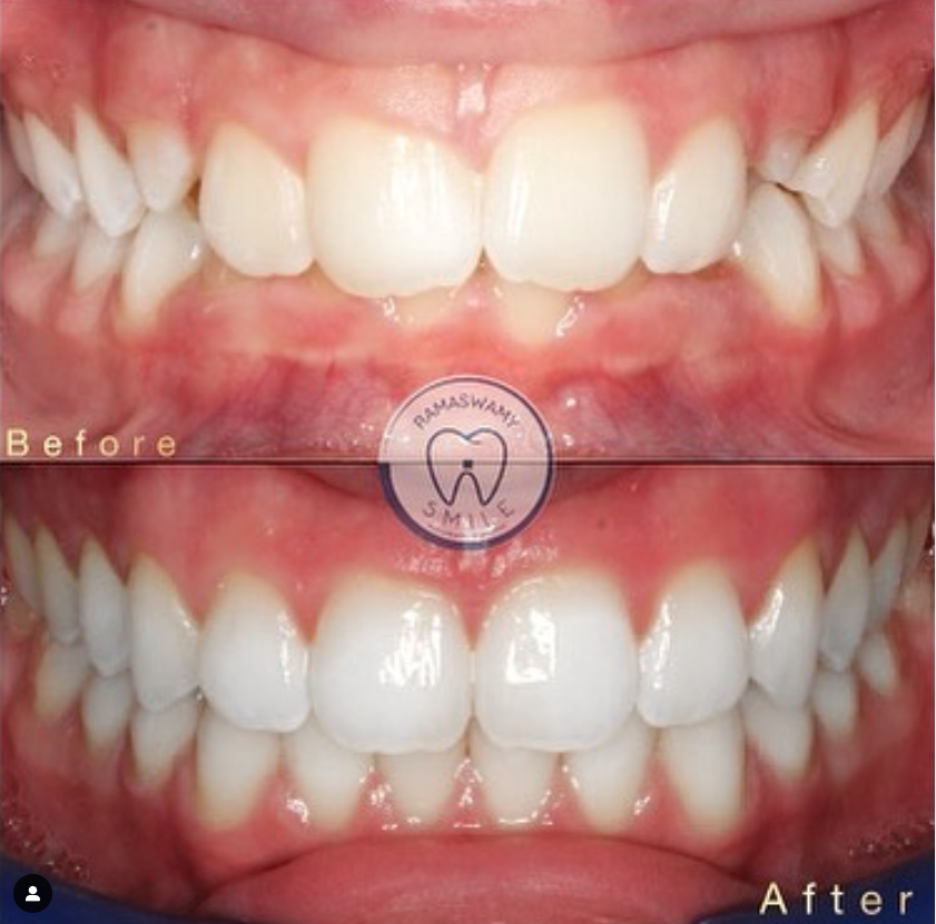 Ramaswamy Orthodontics - Braces, Invisalign Orthodontist | 515 NY-304 Suite 2F-W, New City, NY 10956, USA | Phone: (845) 634-9603