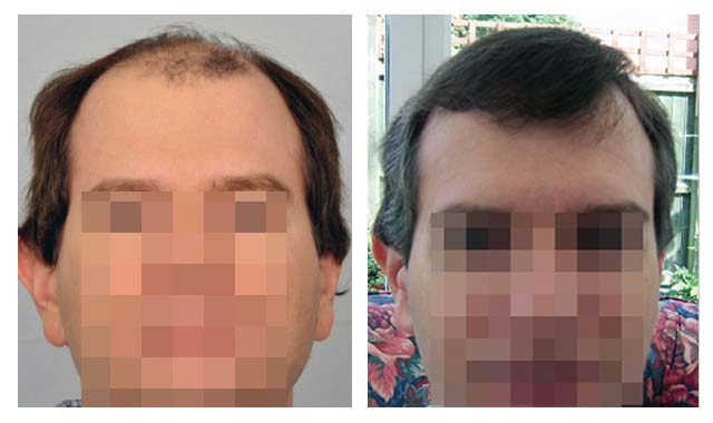 ForHair Hair Transplant Clinic | 1070 Powers Pl, Alpharetta, GA 30009, USA | Phone: (678) 566-1011