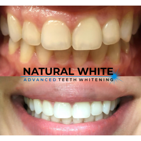 Natural White Clinical Teeth Whitening | 2993 Sandy Plains Rd Suite 125 Office 4, Marietta, GA 30066, USA | Phone: (704) 966-9090