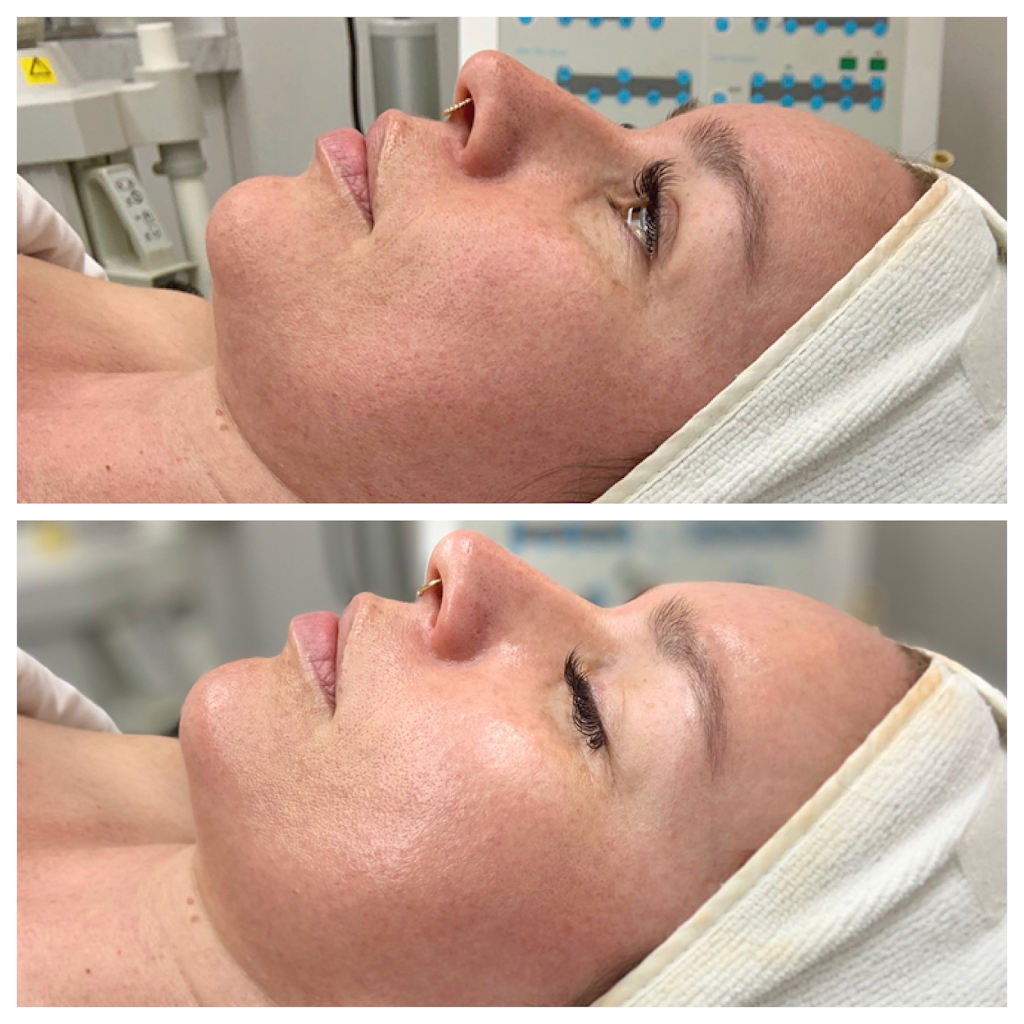 Refine Skin Clinic | 106 N Latah St Ste F, Boise, ID 83706 | Phone: (208) 918-8820