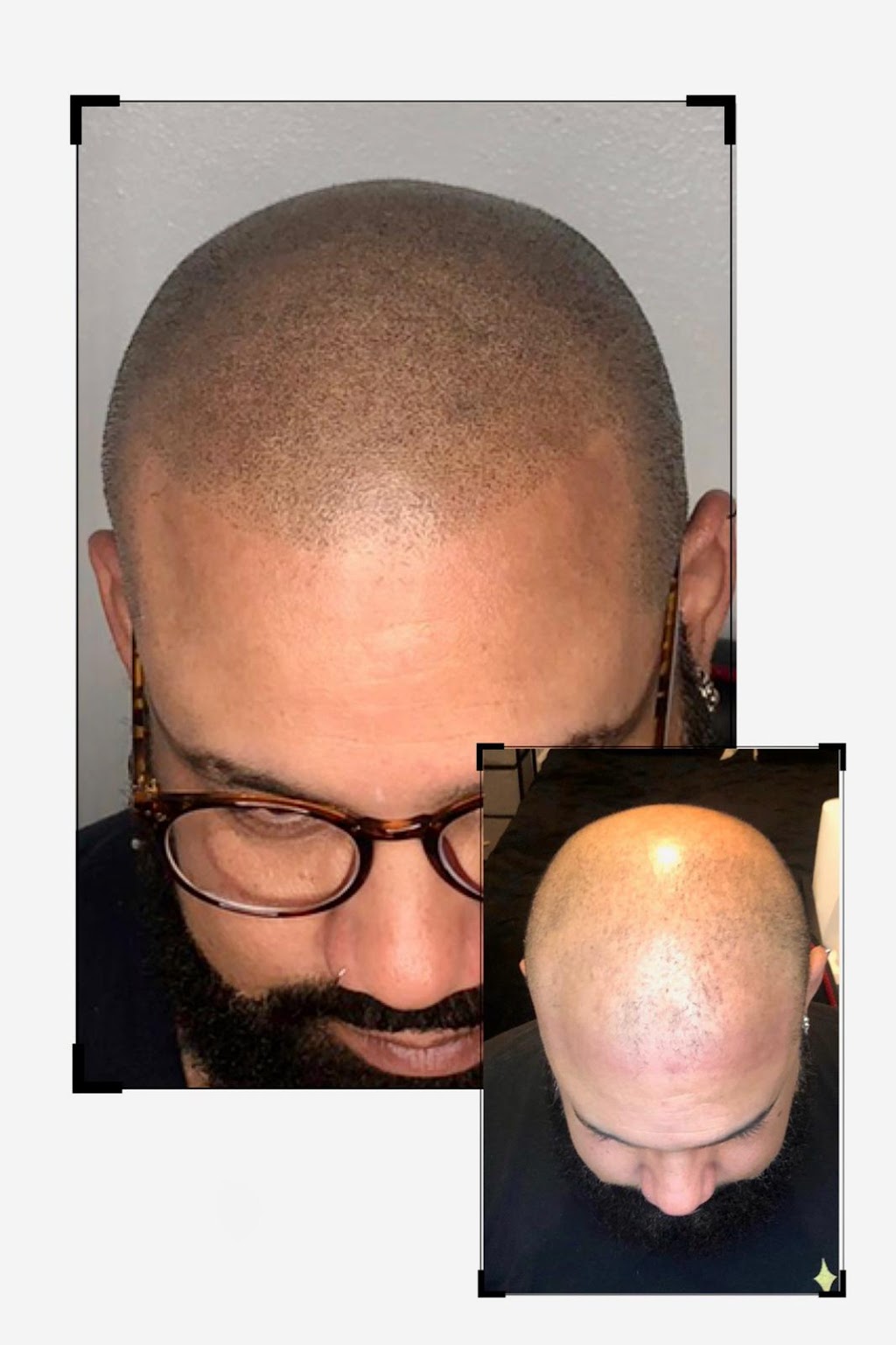 TBS SCALP MICROPIGMENTATION | 304 E 178th St, Bronx, NY 10457, USA | Phone: (646) 655-8483