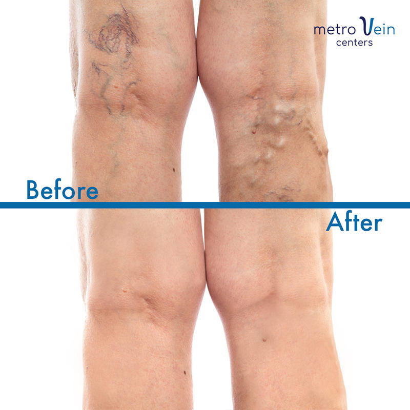 Metro Vein Centers | 34 Mountain Blvd Building A, Suite 203, Warren, NJ 07059, USA | Phone: (908) 574-1267