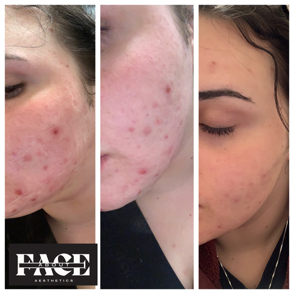 About Face Aesthetics | Studio 12, 588 N Lincoln Ave, Loveland, CO 80537, USA | Phone: (970) 744-3064 About Face Aesthetics | Studio 12, 588 N Lincoln Ave, Loveland, CO 80537, USA | Phone: (970) 744-3064