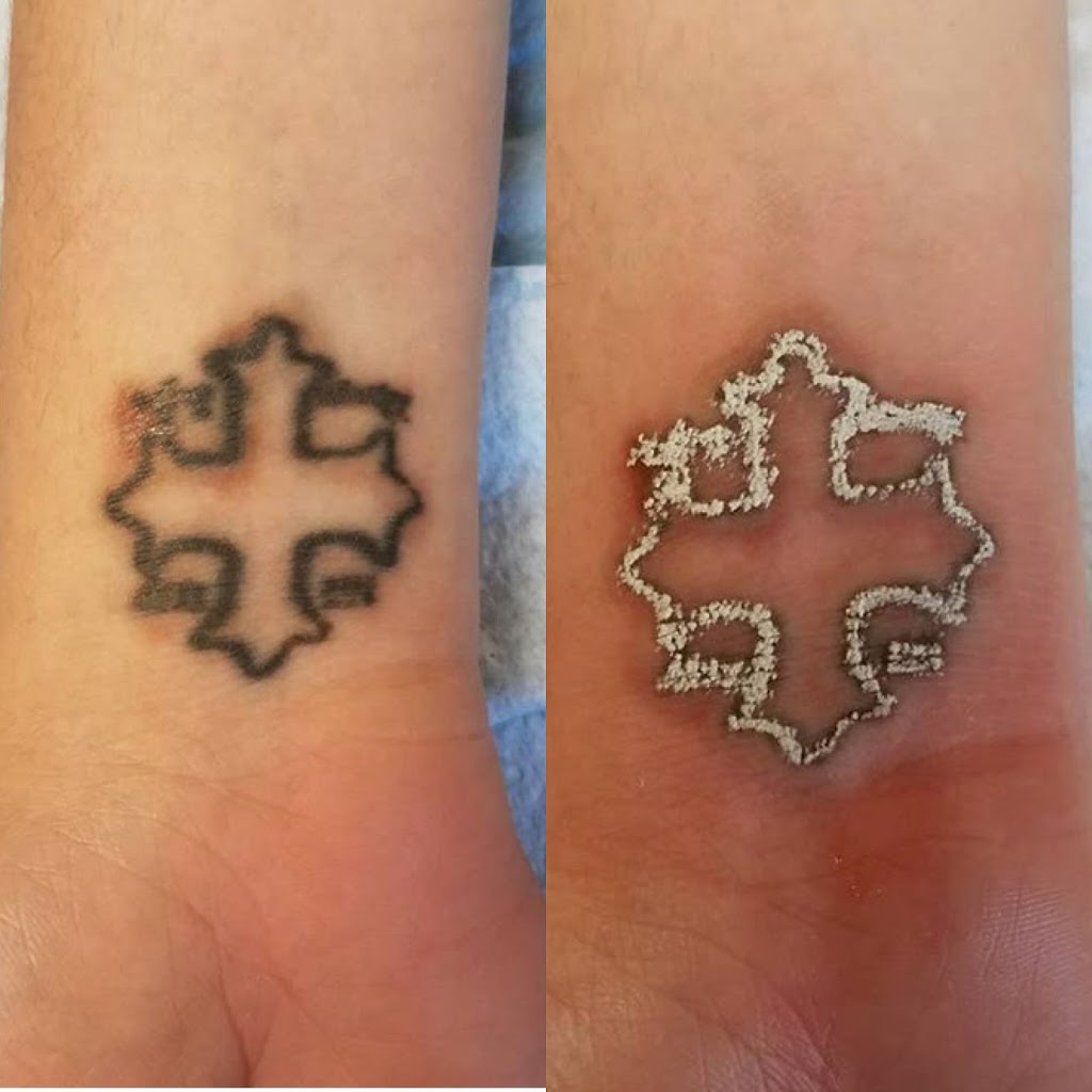 CS Tattoo Removal | 5 S Allen St #2201, Albany, NY 12208, USA | Phone: (518) 689-0730