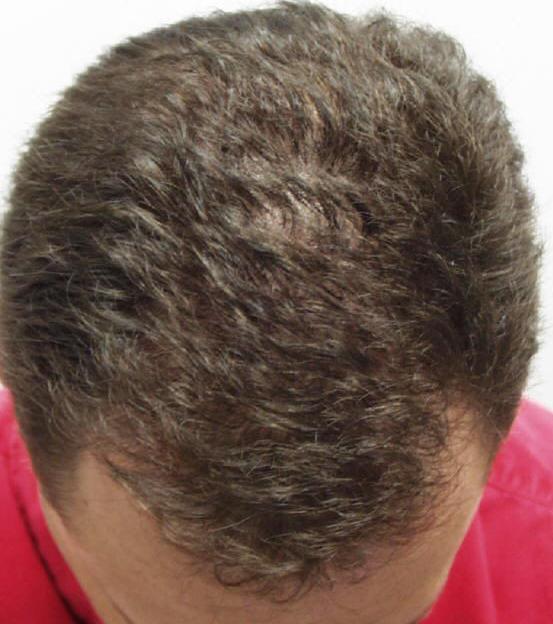 AZ Hair Restoration | 6400 Creedmoor Rd #104, Raleigh, NC 27613, USA | Phone: (919) 830-3778 AZ Hair Restoration | 6400 Creedmoor Rd #104, Raleigh, NC 27613, USA | Phone: (919) 830-3778