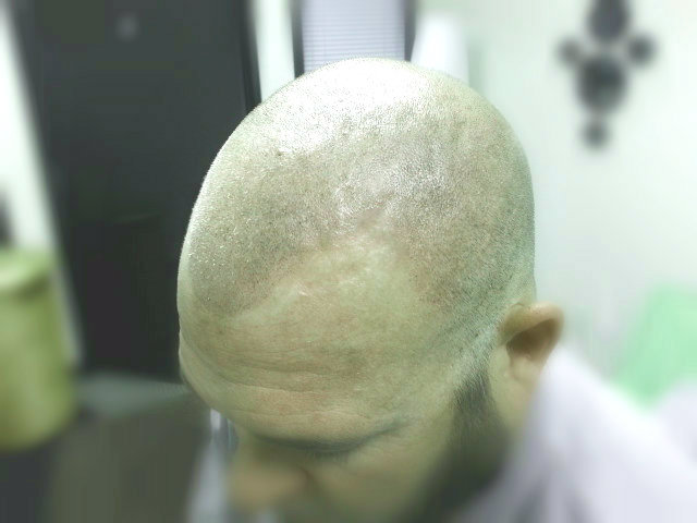 DermiMatch Scalp Micropigmentation | 7320 E Deer Valley Rd Suite 100-A, Scottsdale, AZ 85255, USA | Phone: (480) 788-2432