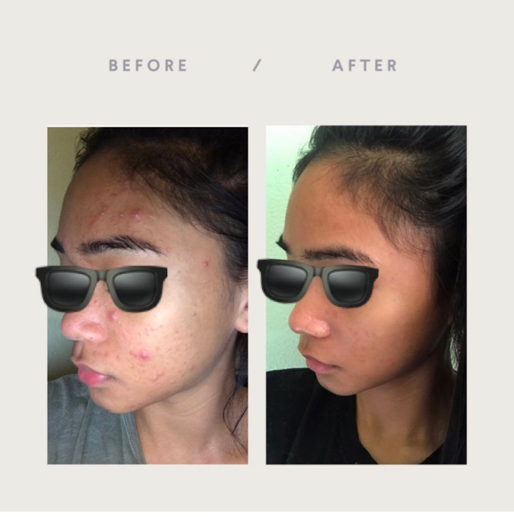 Bare Skin Beauty | 985 W Foothill Blvd # C, Claremont, CA 91711, USA | Phone: (909) 621-2218