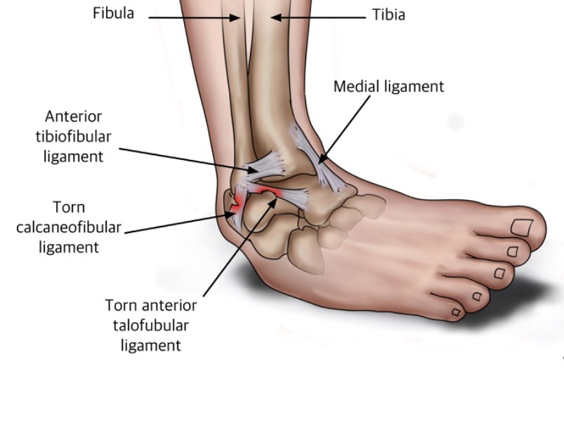 Ace Foot and Ankle Medical Clinic | 333 W El Camino Real #315, Sunnyvale, CA 94087, USA | Phone: (408) 203-3821