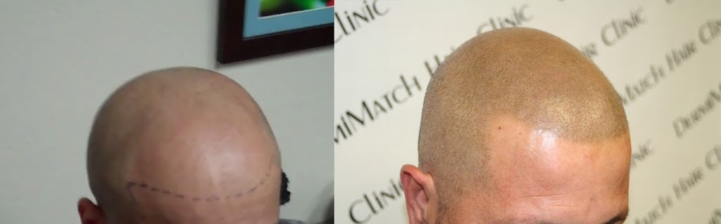 DermiMatch Scalp Micropigmentation | 7320 E Deer Valley Rd Suite 100-A, Scottsdale, AZ 85255, USA | Phone: (480) 788-2432