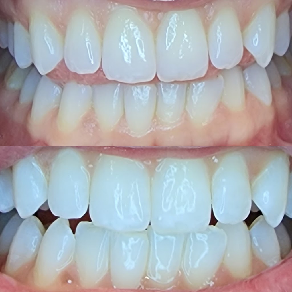 We Whiten Teeth Whitening | 7600 Denton Hwy Suite 101, Watauga, TX 76148, USA | Phone: (682) 334-3389