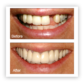 Custom Dentures Lab | 7160 W Glenn Dr, Glendale, AZ 85303, USA | Phone: (623) 845-2155