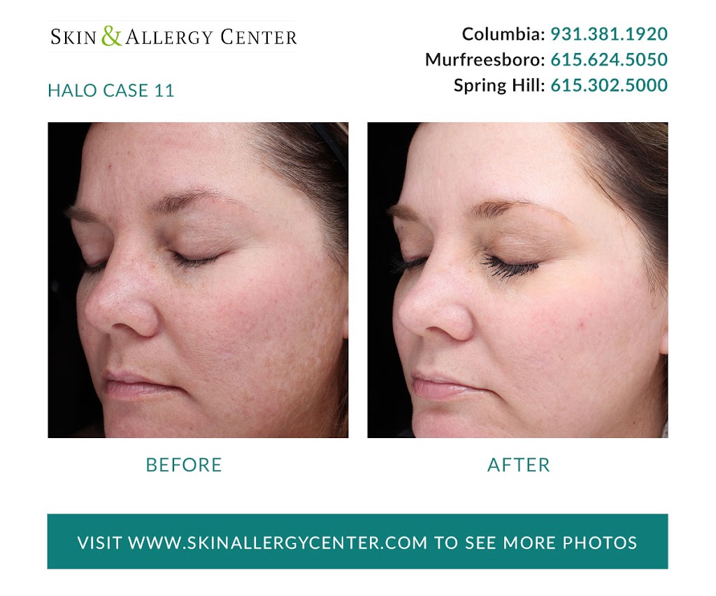 Skin & Allergy Center | 1229 Reserve Blvd Suite 200, Spring Hill, TN 37174, USA | Phone: (615) 302-5000