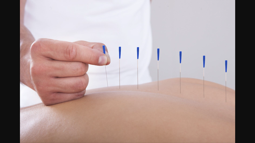 Dr. James Acupuncture | 1712 Brodea Ln, Rocklin, CA 95765 | Phone: (916) 677-9818