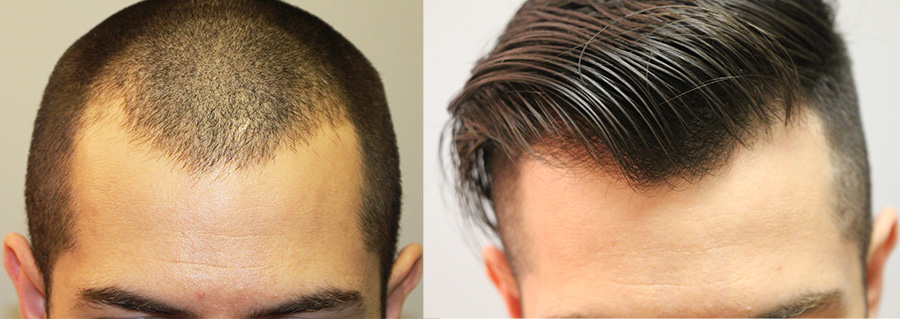 Fallon Hair Restoration | 9735 SW Shady Ln, Tigard, OR 97223, USA | Phone: (503) 941-5029