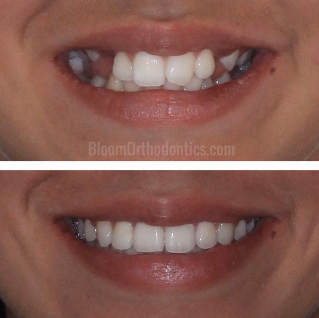 Bloom Orthodontics | 2700 N Bellflower Blvd #212, Long Beach, CA 90815, USA | Phone: (562) 380-0689