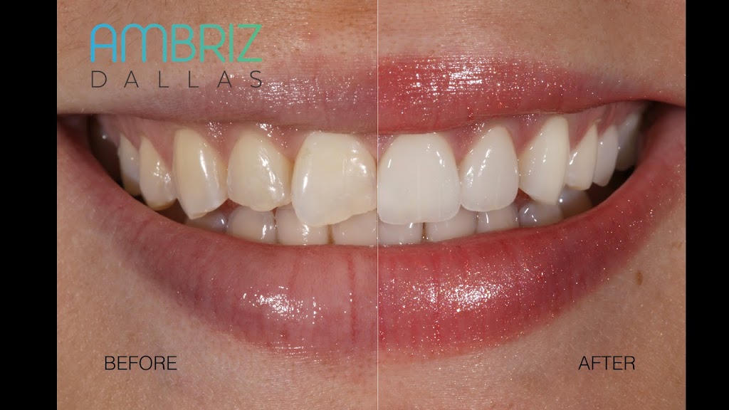 Ambriz Dental | 9400 N US 75-Central Expy 1000 Suite #220, Dallas, TX 75231, USA | Phone: (214) 368-0514