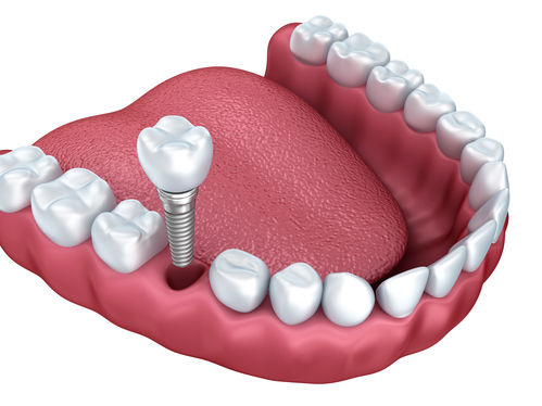 Dental Implant Experts Parker CO | 17021 Lincoln Ave, Parker, CO 80134, USA | Phone: (720) 336-3096