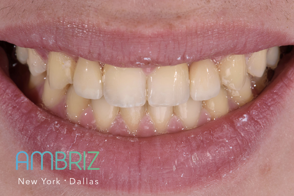 Ambriz Dental | 9400 N US 75-Central Expy 1000 Suite #220, Dallas, TX 75231, USA | Phone: (214) 368-0514