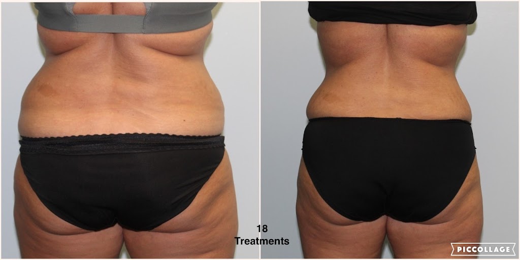 KY UltraSlim | 12400 Shelbyville Rd, Louisville, KY 40243, USA | Phone: (502) 501-9660