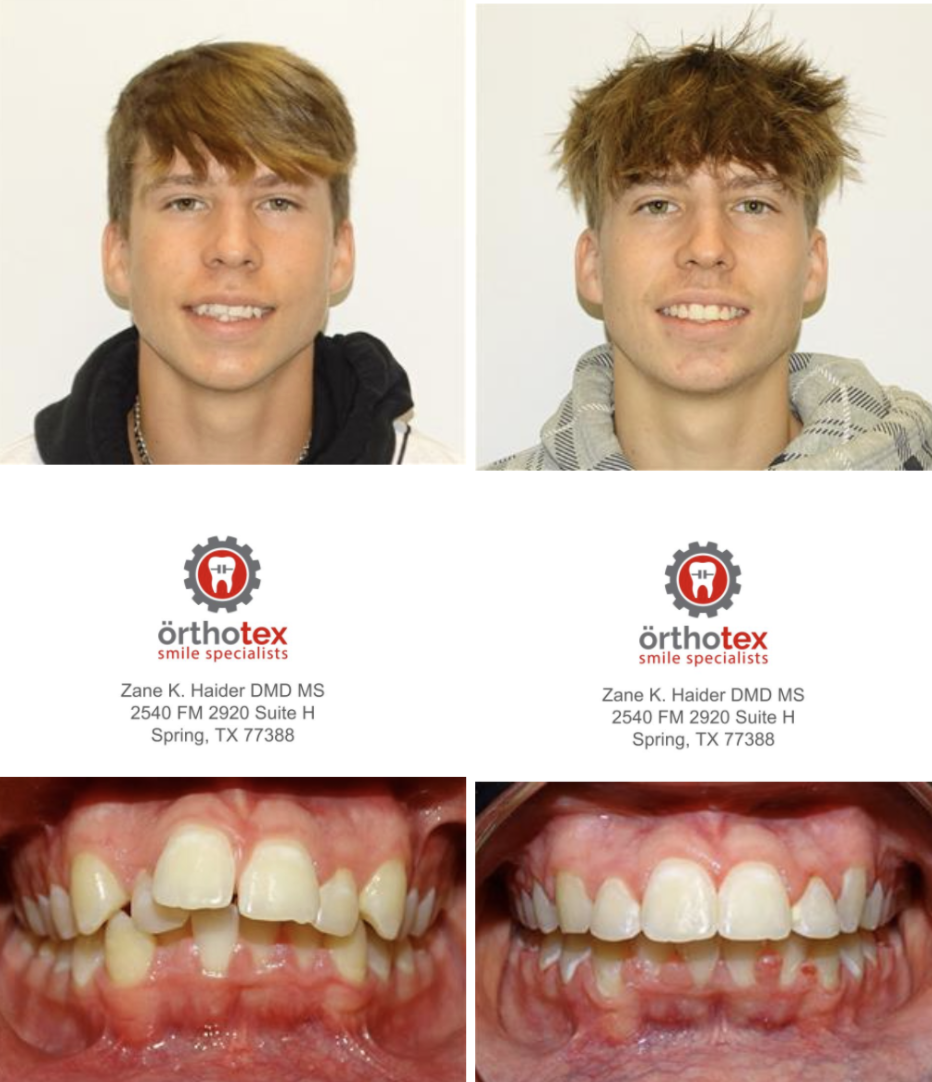 Orthotex Smile Specialists | 2540 Farm to Market 2920, Spring, TX 77388, USA | Phone: (281) 937-2540