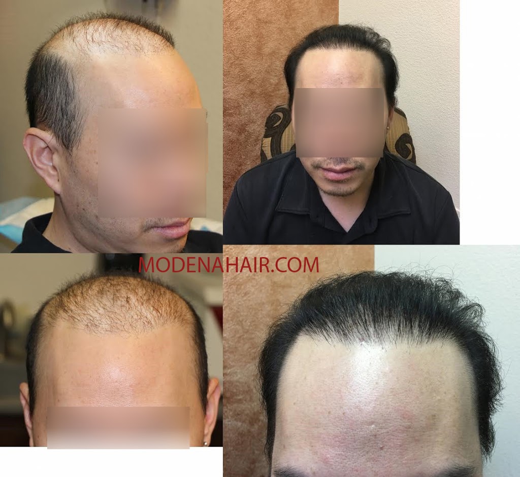 Modena Hair Transplant Institute | 2629 W Horizon Ridge Pkwy Suite #110, Henderson, NV 89052, USA | Phone: (702) 966-5134 Modena Hair Transplant Institute | 2629 W Horizon Ridge Pkwy Suite #110, Henderson, NV 89052, USA | Phone: (702) 966-5134