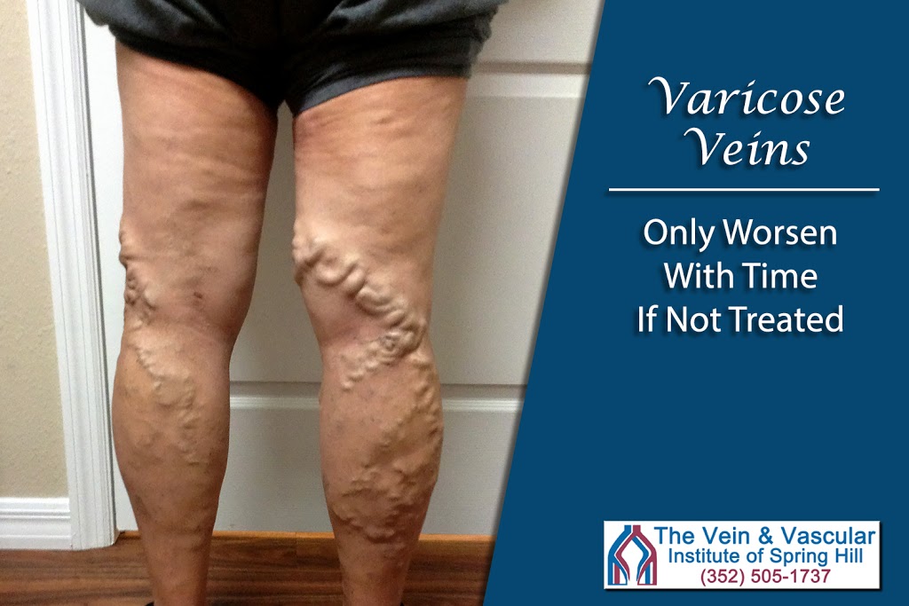 The Vein and Vascular Institute of Tampa Bay | 19185 N Dale Mabry Hwy, Lutz, FL 33548, United States | Phone: (813) 348-9088