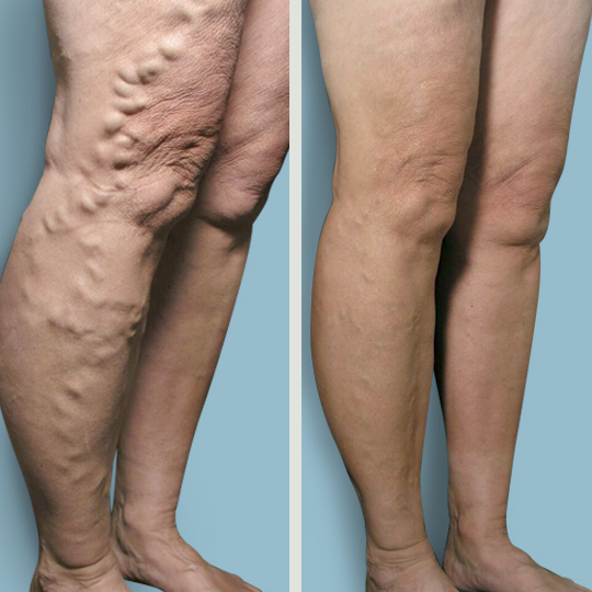 Metro Vein Centers | Brick | 525 Jack Martin Blvd Ste 200, Brick Township, NJ 08724, USA | Phone: (732) 374-9217