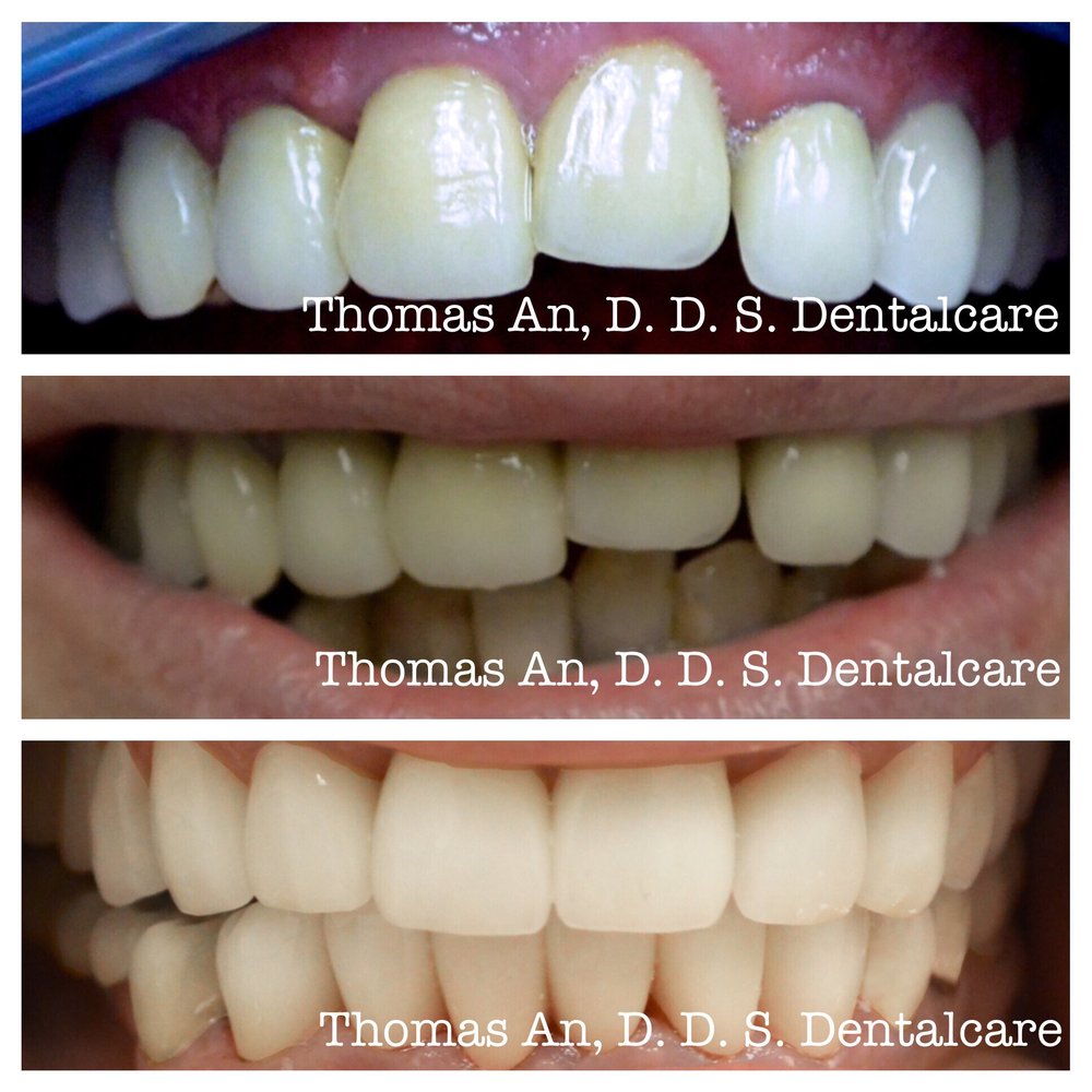 Thomas An, D.D.S. Dentalcare | 7149 Katella Ave, Stanton, CA 90680, USA | Phone: (714) 252-9240