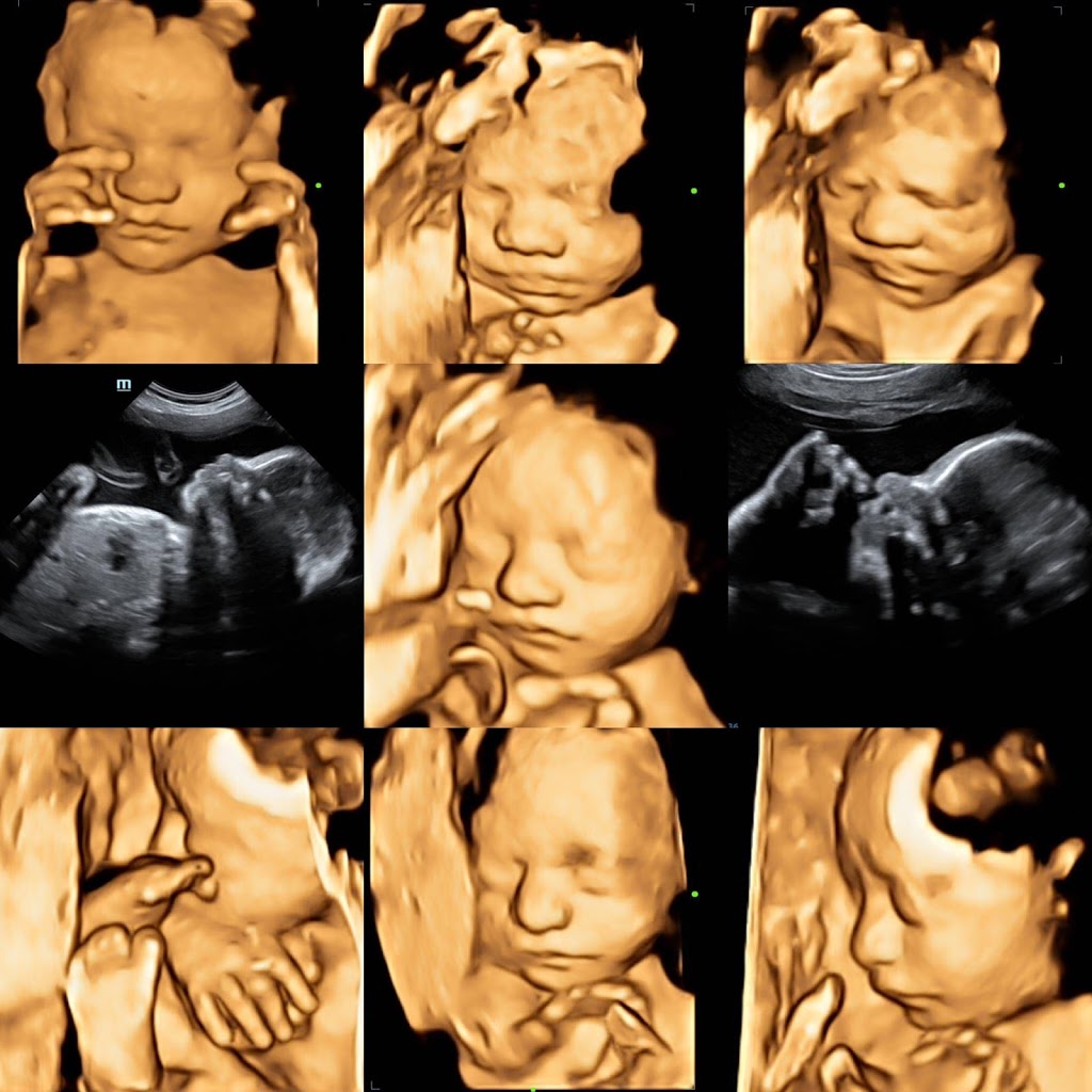 Stork Vision Dallas 3D/4D/HD Ultrasound | 3317 McKinney Ave # 201, Dallas, TX 75204, USA | Phone: (469) 999-8630